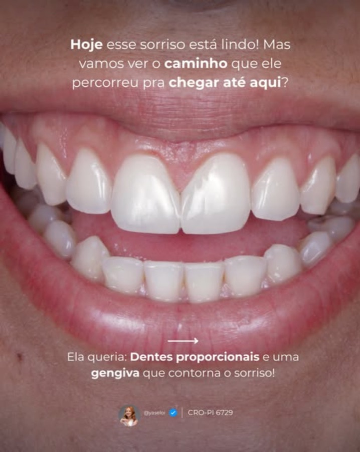 Sorriso após facetas em resina